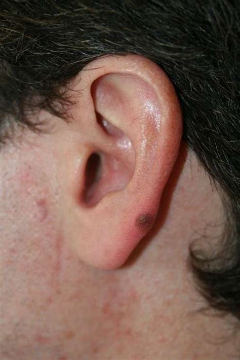 pictures of melanoma skin cancer on ear